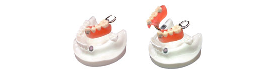 MAGFIT RKR – Chốt dùng cho chân răng tự nhiên kết nối nam châm