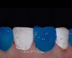 Kỹ thuật Flowable Injection: Cuộc cách mạng của Composite lỏng