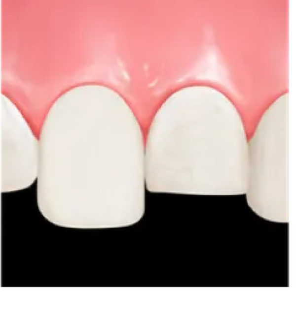 COMPOSITE LỎNG TỶ LỆ HẠT ĐỘN CAO - CLEARFIL MAJESTY ES FLOW UNIVERSAL